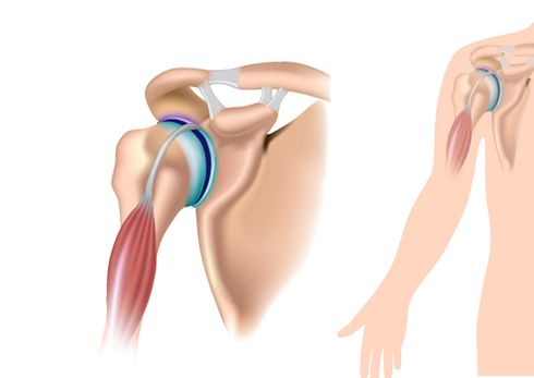 Chirurgie de l'épaule