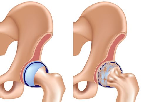 Chirurgie de la hanche à Colmar (68000 - Haut-Rhin)