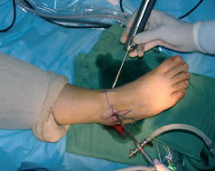 Vue opératoire d’une arthroscopie de cheville
