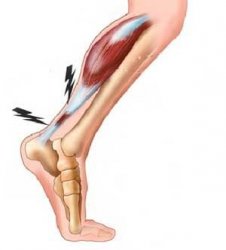 Tendinopathie d'Achille