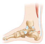 Conflit du tendon d'Achille