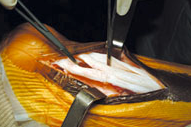 Opération peignage tendon d'Achille