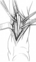 Schéma peignage tendon d'Achille