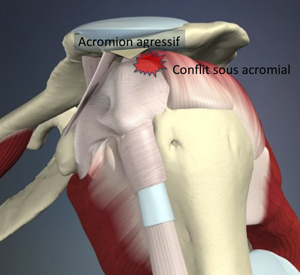 Acromion agressif
