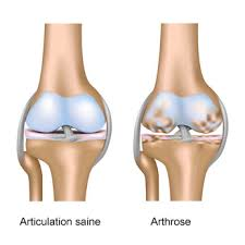 Articulation saine et avec arthrose