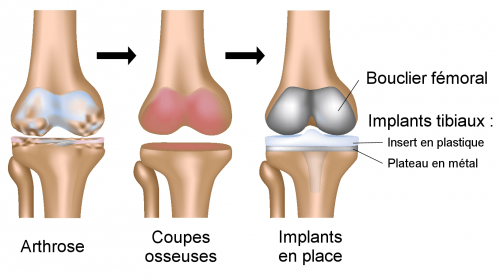 Prothèse de genou