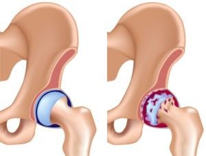 L’arthrose de la hanche (coxarthrose) : il s'agit d'une destruction du cartilage gênant ainsi le glissement de la tête du fémur dans le cotyle