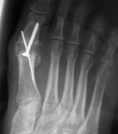 Arthrodèse de l’articulation métatarso-phalangienne de l’hallux