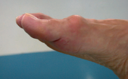 Hallux rigidus avec dorsal bunion