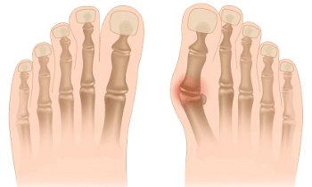 Hallux valgus