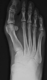 Opération de l'hallux valgus