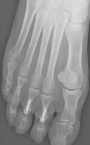 Radiographie à deux mois d’une arthrodèse des deuxième et troisième orteils
